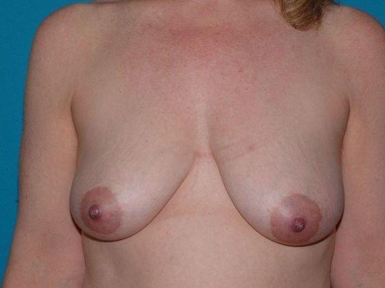Breast Lift before at Carmel Cosmetic and Plastic Surgeons in Carmel, IN