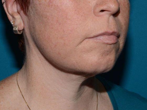 Deep Plane Facelift after at Carmel Cosmetic and Plastic Surgeons in Carmel, IN