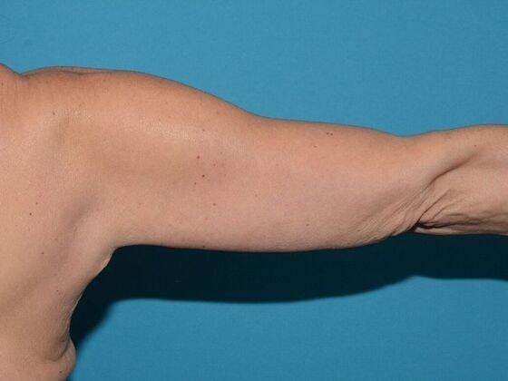 Arm Lift after at Carmel Cosmetic and Plastic Surgeons in Carmel, IN