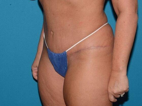Mini Tummy Tuck after at Carmel Cosmetic and Plastic Surgeons in Carmel, IN