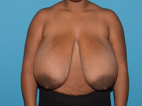 Breast Reduction before at Carmel Cosmetic and Plastic Surgeons in Carmel, IN