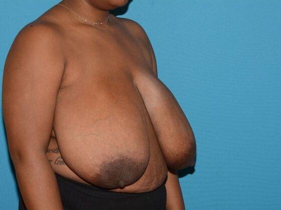 Breast Reduction before at Carmel Cosmetic and Plastic Surgeons in Carmel, IN