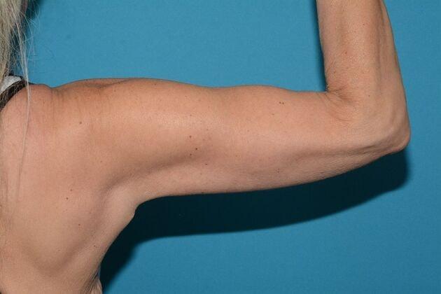 Arm Lift after at Carmel Cosmetic and Plastic Surgeons in Carmel, IN