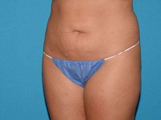 Liposuction before at Carmel Cosmetic and Plastic Surgeons in Carmel, IN