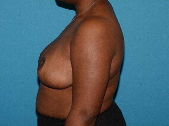 Breast Reduction after at Carmel Cosmetic and Plastic Surgeons in Carmel, IN