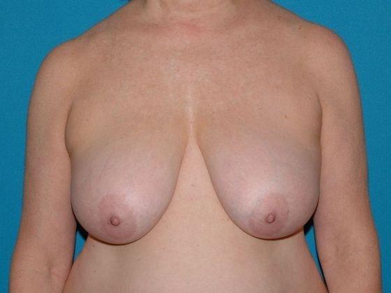 Breast Lift before at Carmel Cosmetic and Plastic Surgeons in Carmel, IN