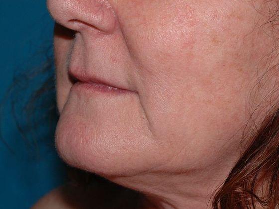 Fat Transfer after at Carmel Cosmetic and Plastic Surgeons in Carmel, IN