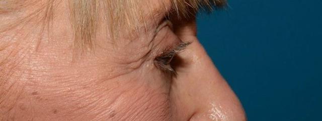 Blepharoplasty after at Carmel Cosmetic and Plastic Surgeons in Carmel, IN