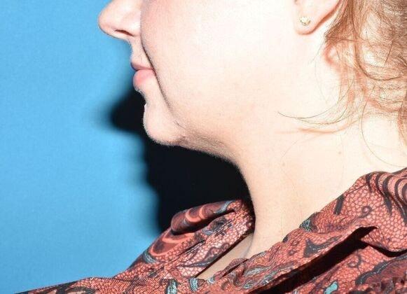 Neck Liposuction after at Carmel Cosmetic and Plastic Surgeons in Carmel, IN