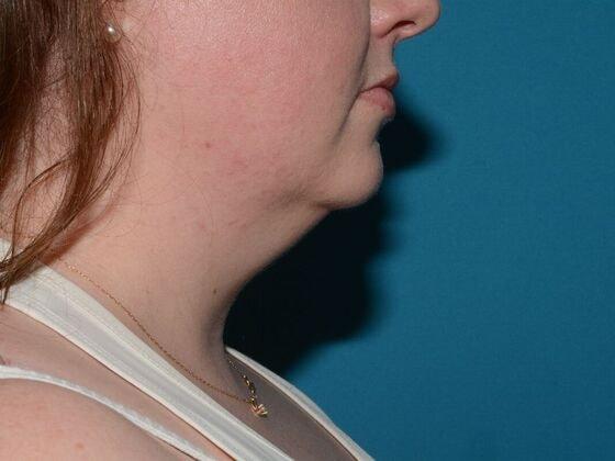 Neck Liposuction before at Carmel Cosmetic and Plastic Surgeons in Carmel, IN