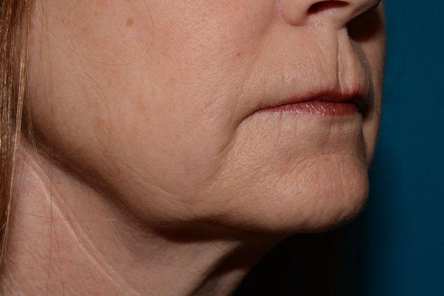 Fat Transfer after at Carmel Cosmetic and Plastic Surgeons in Carmel, IN