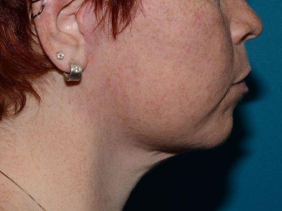 Deep Plane Facelift after at Carmel Cosmetic and Plastic Surgeons in Carmel, IN