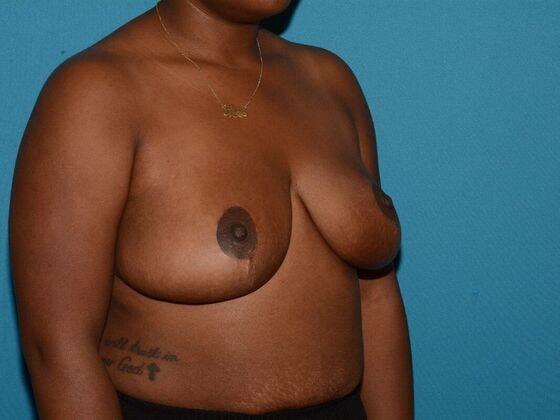 Breast Reduction after at Carmel Cosmetic and Plastic Surgeons in Carmel, IN