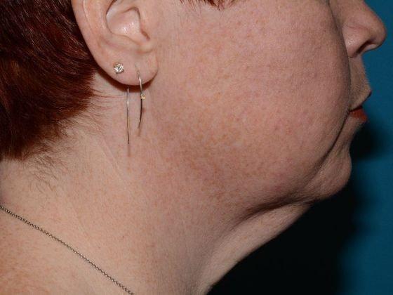 Deep Plane Facelift before at Carmel Cosmetic and Plastic Surgeons in Carmel, IN