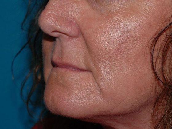 Fat Transfer before at Carmel Cosmetic and Plastic Surgeons in Carmel, IN