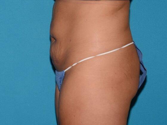 Liposuction before at Carmel Cosmetic and Plastic Surgeons in Carmel, IN