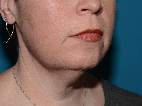 Deep Plane Facelift before at Carmel Cosmetic and Plastic Surgeons in Carmel, IN