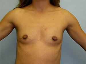 Breast Augmentation before at Adam J. Rubinstein, MD, FACS in Aventura, FL