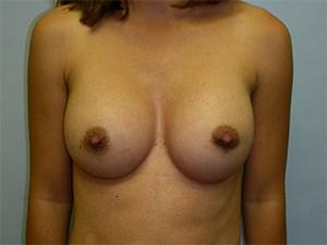 Adam J. Rubinstein, MD, FACS breast augmentation after — Miami, FL
