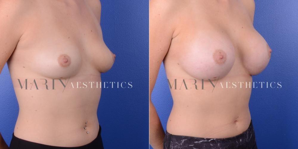 Marin Aesthetics breast augmentation result — San Diego, CA