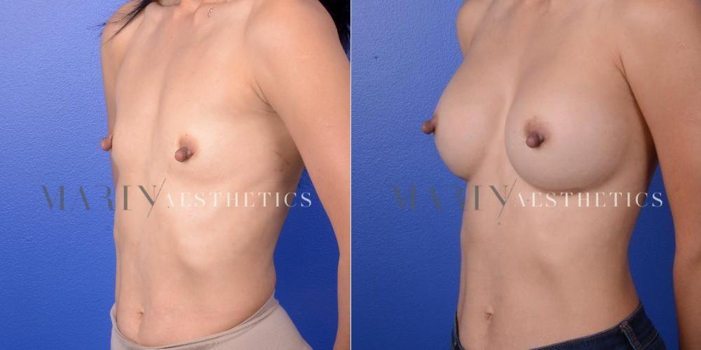 Marin Aesthetics breast augmentation result — San Diego, CA