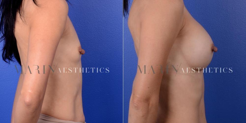 Marin Aesthetics breast augmentation result — San Diego, CA