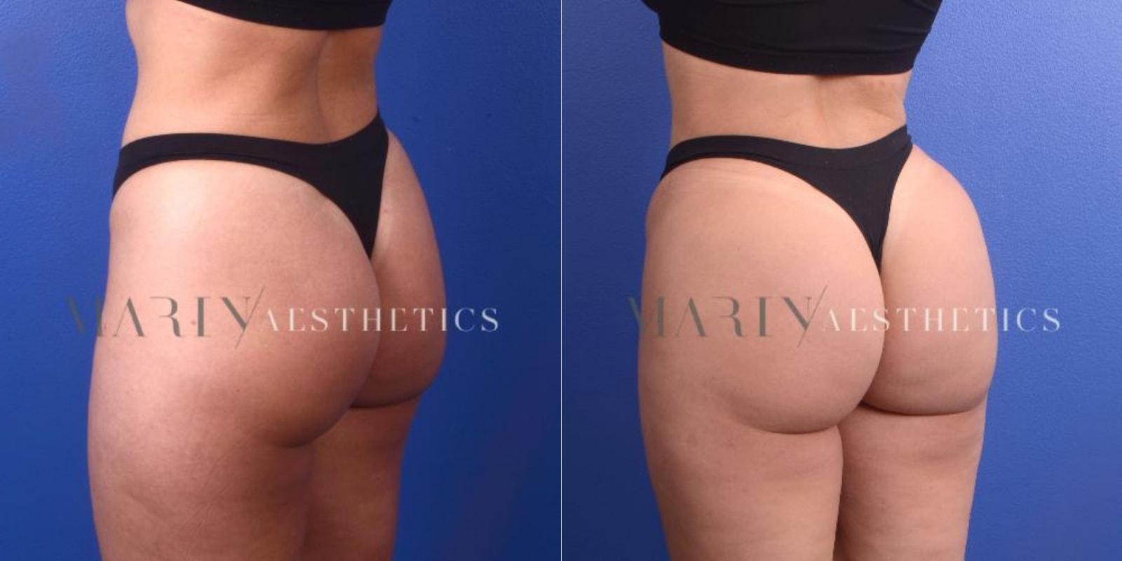Marin Aesthetics bbl result — San Diego, CA
