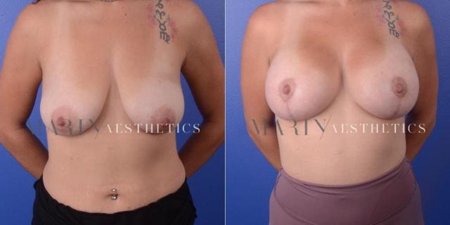 Breast Lift result at Marin Aesthetics in San Diego, CA