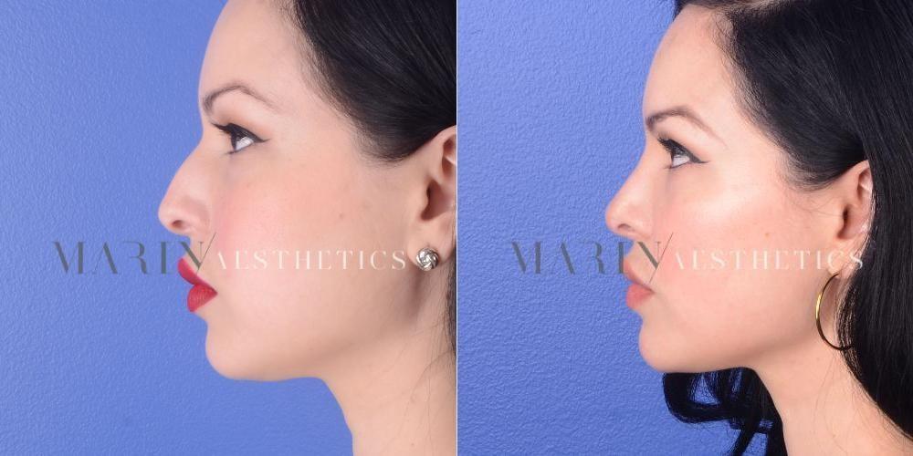 Marin Aesthetics rhinoplasty result — San Diego, CA