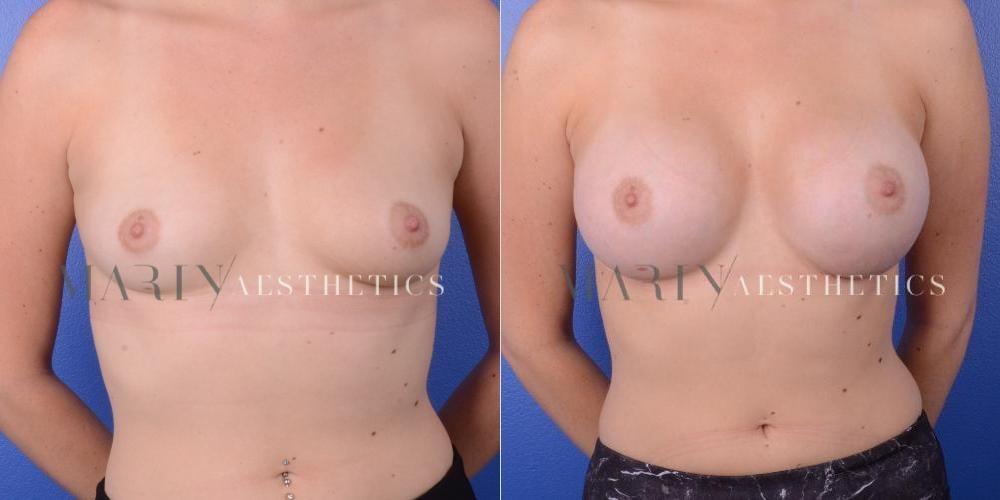 Marin Aesthetics breast augmentation result — San Diego, CA