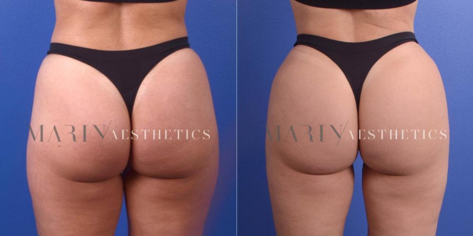 Marin Aesthetics bbl result — San Diego, CA