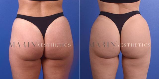 Brazilian Butt Lift result at Marin Aesthetics in San Diego, CA