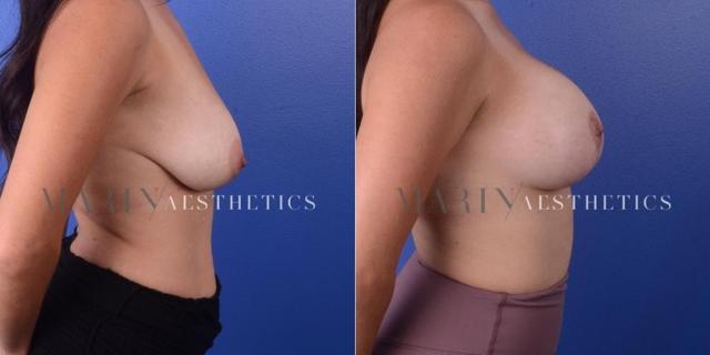 Breast Lift result at Marin Aesthetics in San Diego, CA