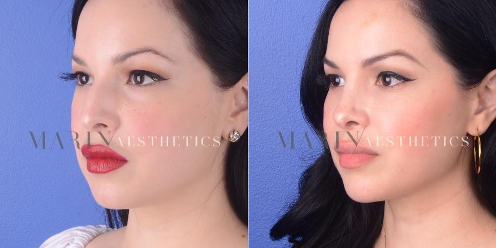 Marin Aesthetics rhinoplasty result — San Diego, CA