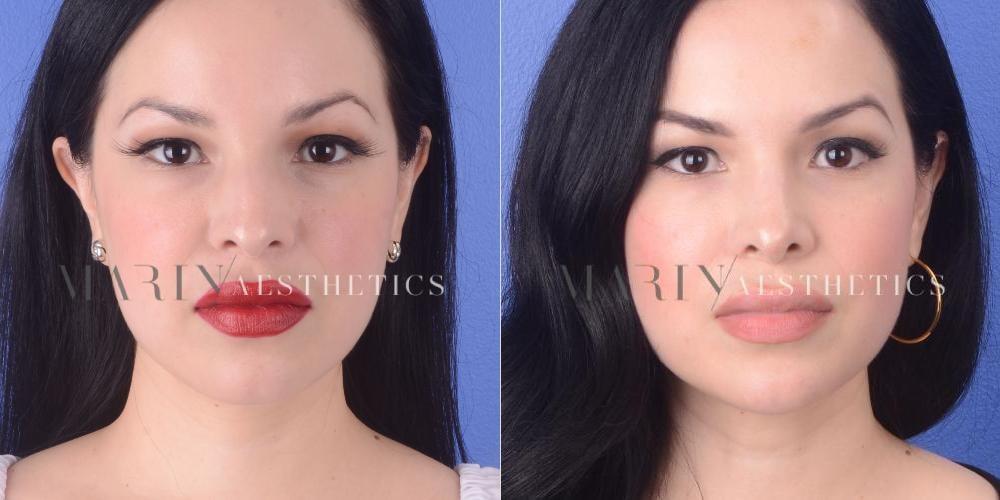 Marin Aesthetics rhinoplasty result — San Diego, CA