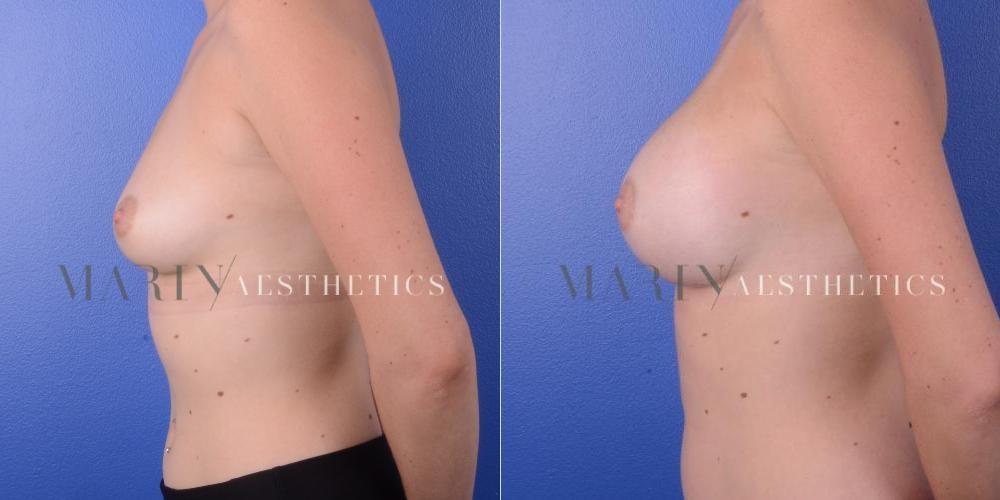 Marin Aesthetics breast augmentation result — San Diego, CA