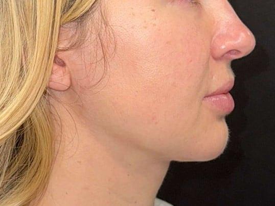 Nuance Medspa neck liposuction after — Vancouver, WA