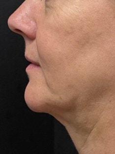 Nuance Medspa neck liposuction after — Vancouver, WA