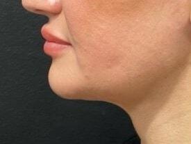 Nuance Medspa neck liposuction after — Vancouver, WA