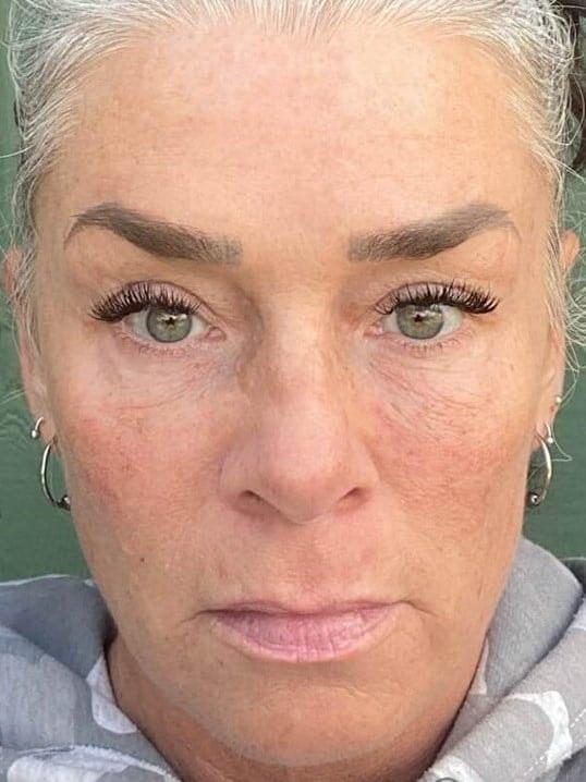 Dermal Fillers after at Nuance Medspa in Vancouver, WA