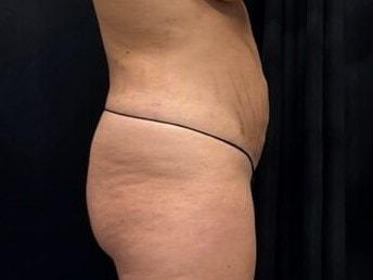Nuance Medspa liposuction after — Vancouver, WA