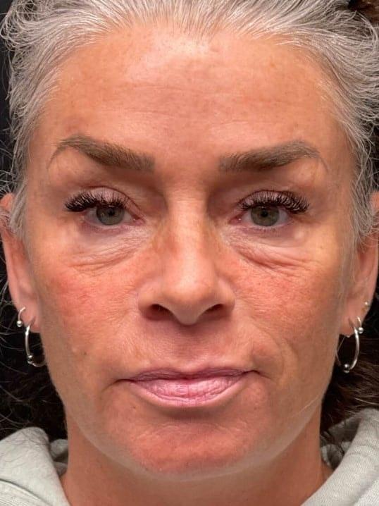 Dermal Fillers before at Nuance Medspa in Vancouver, WA