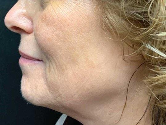 Nuance Medspa microneedling after — Vancouver, WA