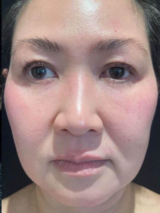 Nuance Medspa fat transfer after — Vancouver, WA