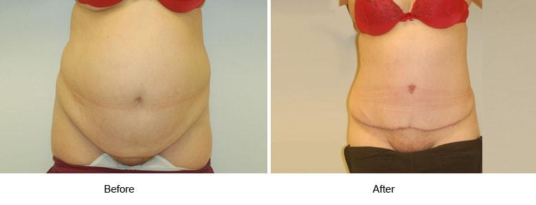 Shahin Javaheri, MD tummy tuck result — Berkeley, CA