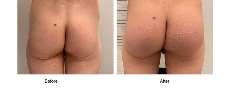 Shahin Javaheri, MD body contouring result — Berkeley, CA
