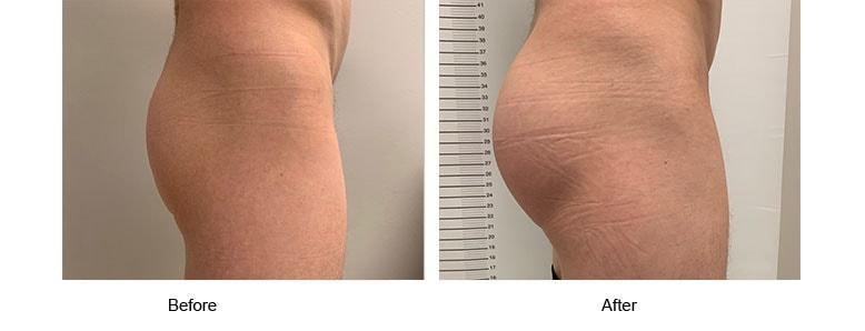 Shahin Javaheri, MD body contouring result — Berkeley, CA