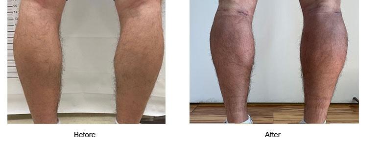 Shahin Javaheri, MD body contouring result — Berkeley, CA