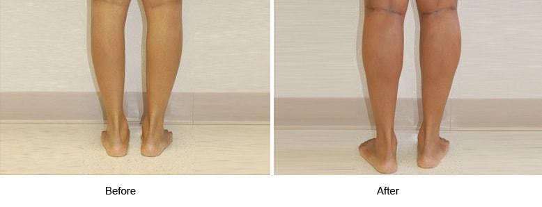 Shahin Javaheri, MD body contouring result — Berkeley, CA