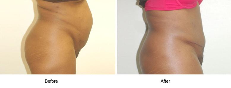 Shahin Javaheri, MD tummy tuck result — Berkeley, CA